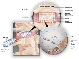 i-FACTOR™ Bone Graft – Enhanced Healing processes for Growth - Medical ...